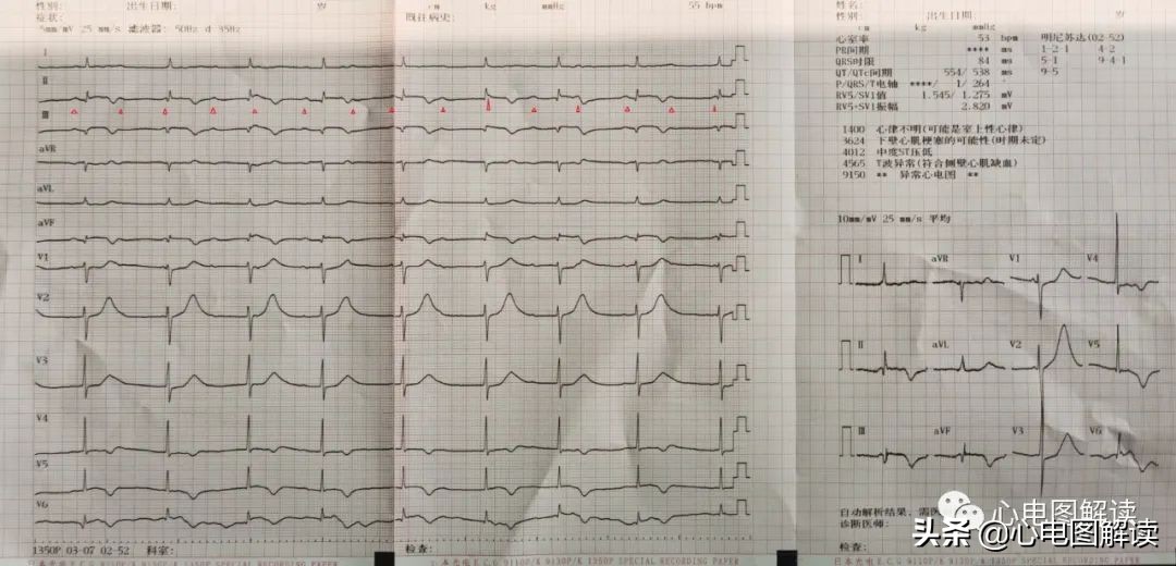 三度房室传导阻滞 一度房室阻滞严重吗