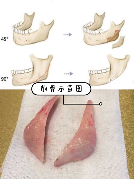 现在磨骨大概多少钱独家揭秘