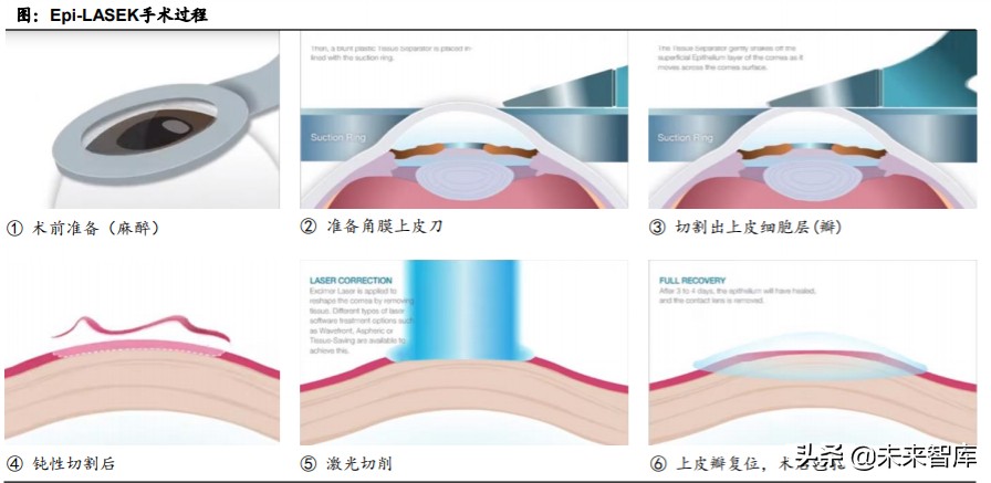 眼科產業鏈深度報告：創新驅動，服務為王