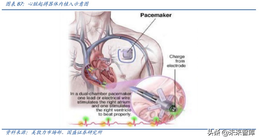 乐普医疗深度解析：布局心血管医疗全产业链，不断创新发展