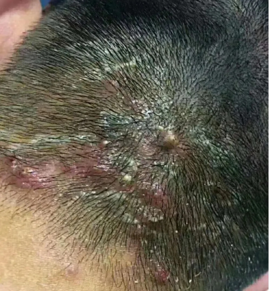 毛囊炎怎么治疗 毛囊炎怎么治疗最快的方法