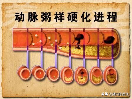 动脉粥样硬化 动脉粥样硬化能活多久