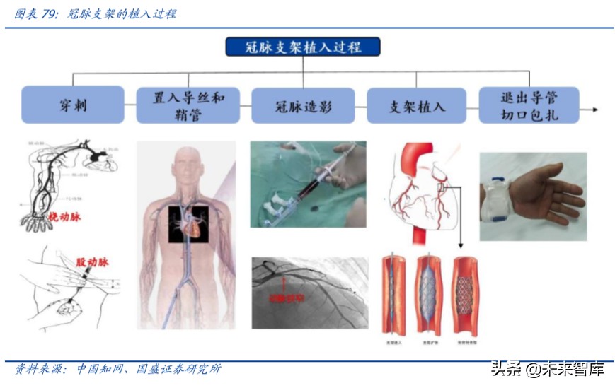 乐普医疗深度解析：布局心血管医疗全产业链，不断创新发展