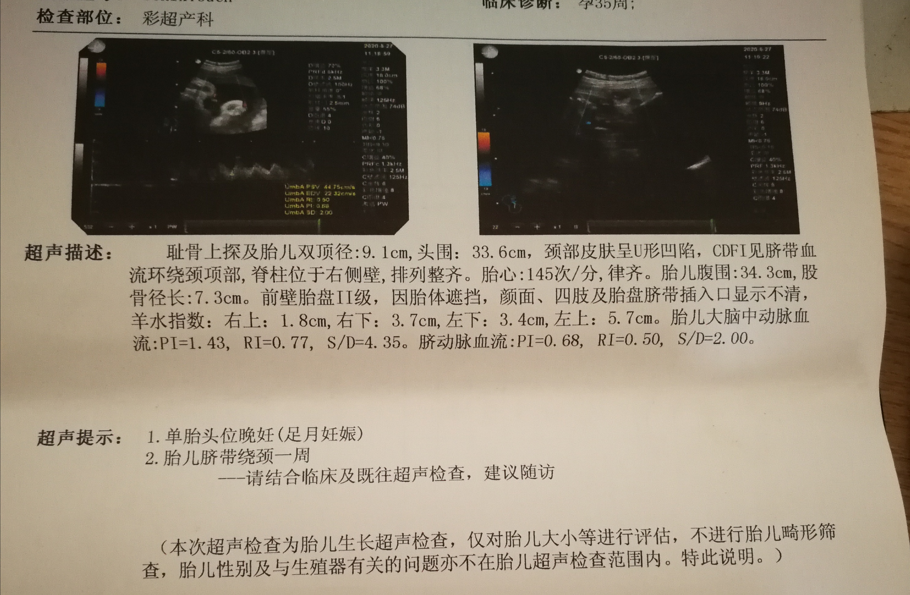 脐带绕颈一周怎么办 脐带绕颈一周怎么办能顺产吗