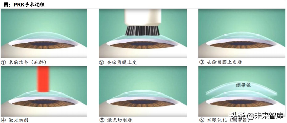 眼科產業鏈深度報告：創新驅動，服務為王