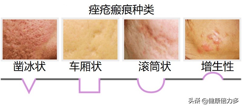 罗红霉素胶囊 红霉素的五大副作用