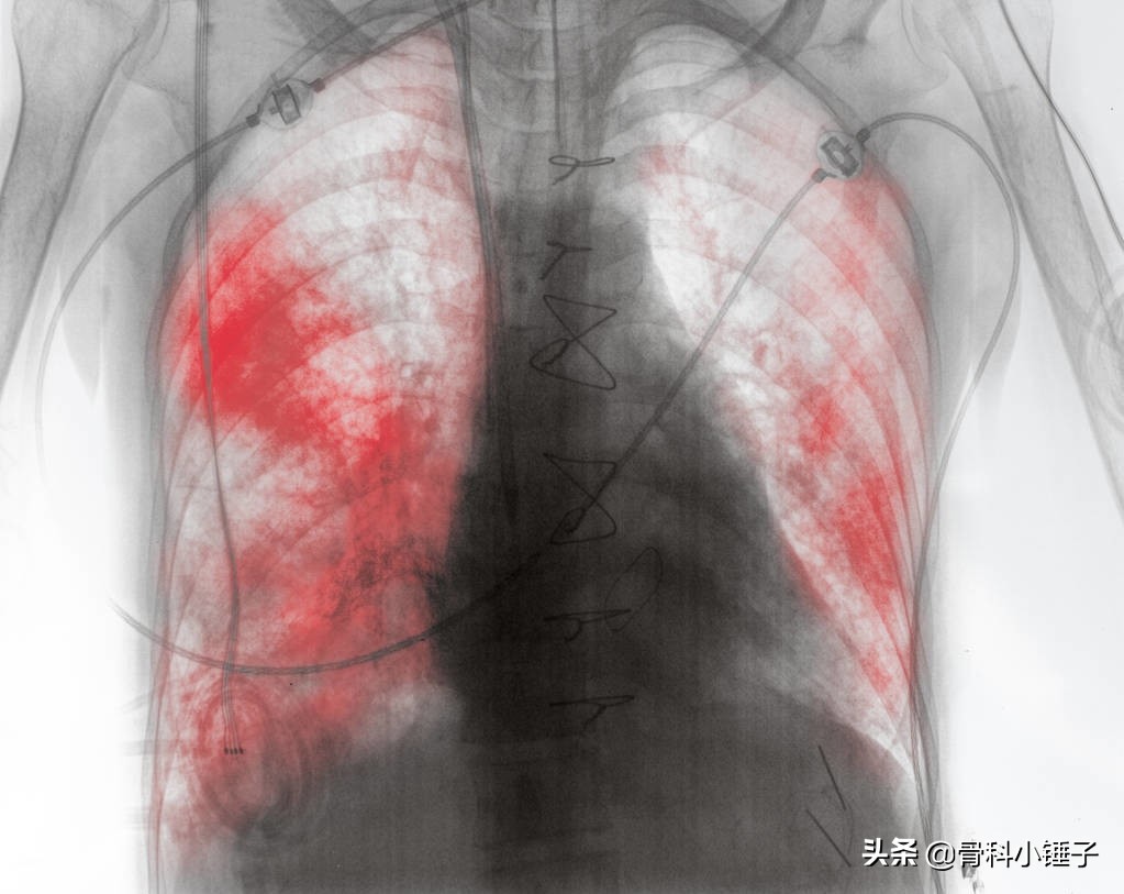 带状疱疹后遗症 带状疱疹后遗症神经痛怎么根治