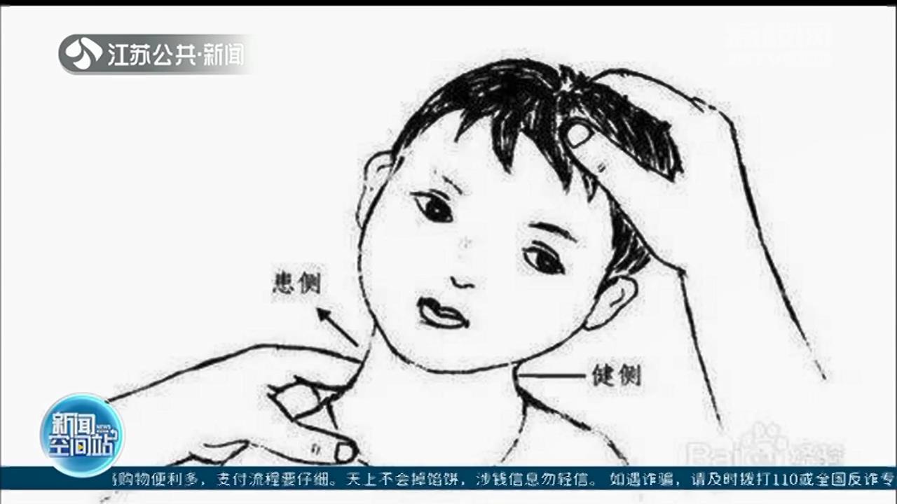 孩子总爱歪头杀卖萌小心患上先天性肌性斜颈