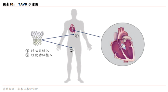 医药生物行业专题：TAVR 有望成为未来主动脉瓣膜疾病的治疗趋势