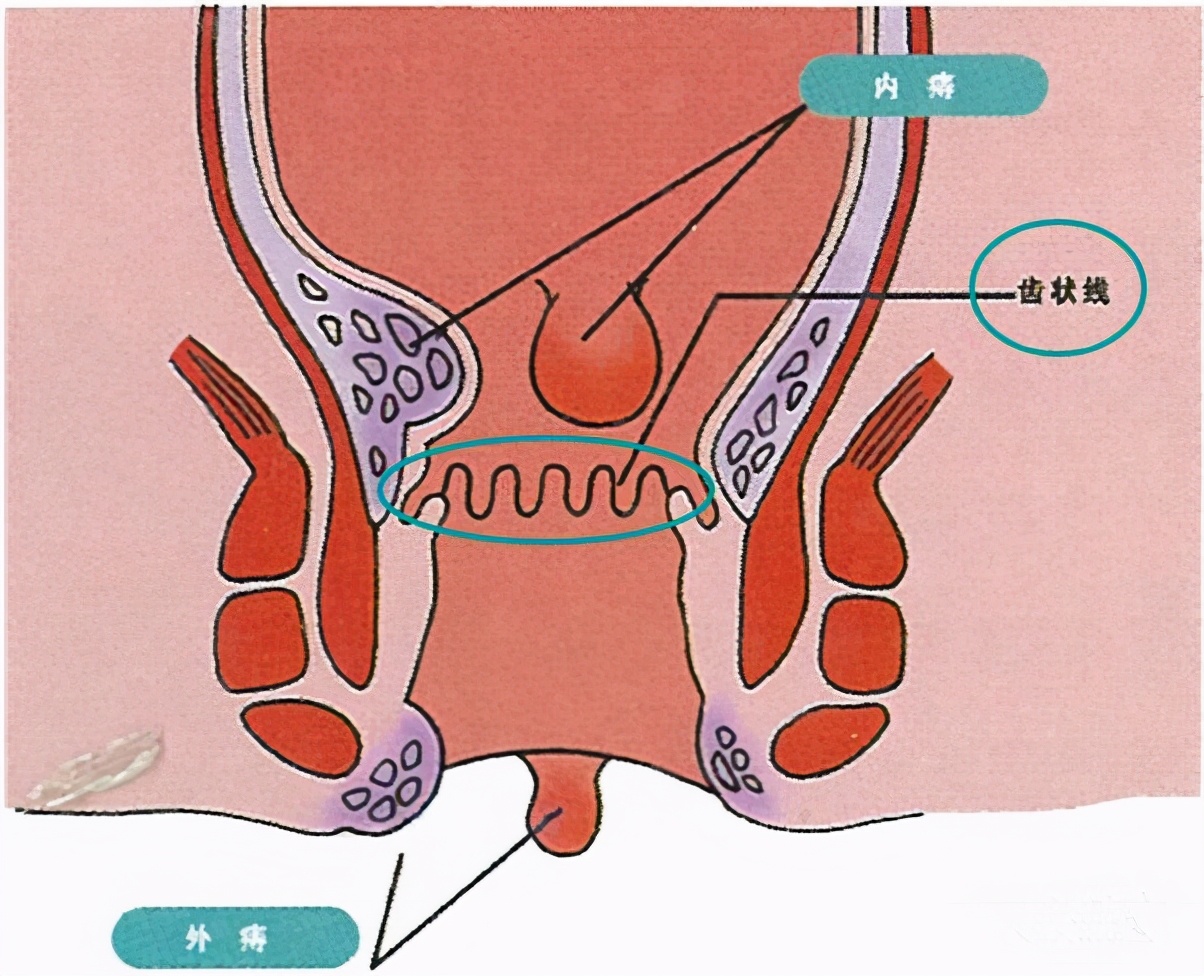 肛裂图片肛肠疾病的四大金刚