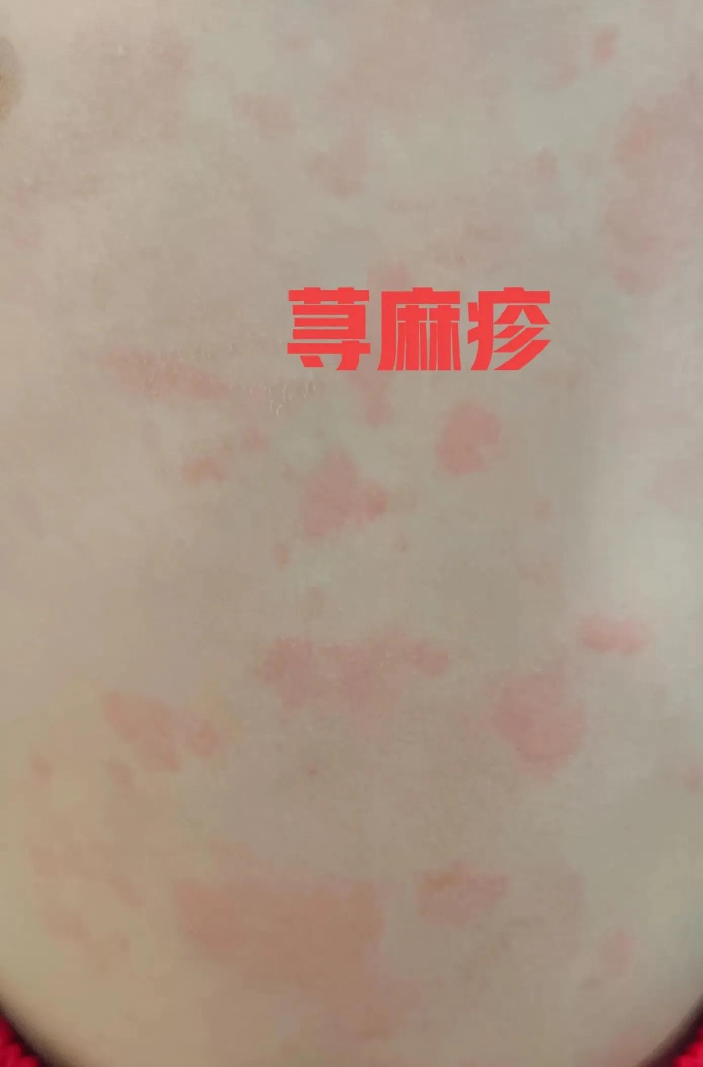 皮肤病的种类图片 小儿皮肤病的种类图片
