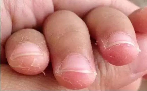 手指脱皮是什么原因 手指脱皮是什么原因导致的