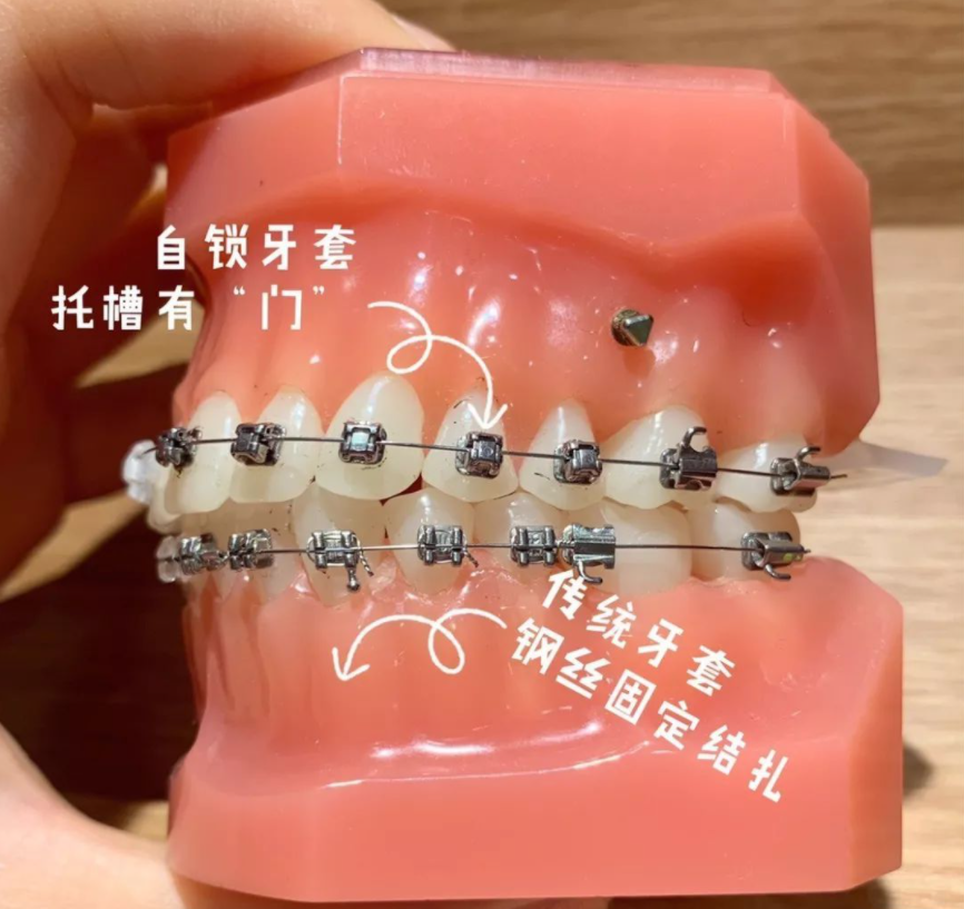 这种牙套是粘在牙齿上固定起来的,由弓丝,带环,托槽和附件组成的.