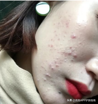 莫匹罗星软膏 莫匹罗星软膏可以治痘痘吗