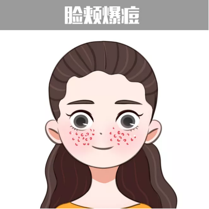 左脸颊长痘的原因 左脸颊长痘的原因以及怎么解决