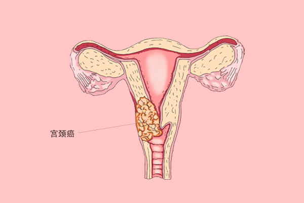 宫颈肥大图片 宫颈口长息肉的图片