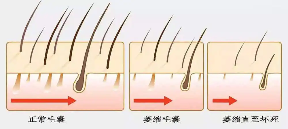 脂溢性脱发 怎么激活坏毛囊生发