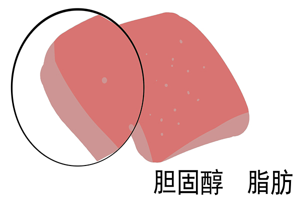 高密度脂蛋白胆固醇 低密度脂蛋白3.8严重吗