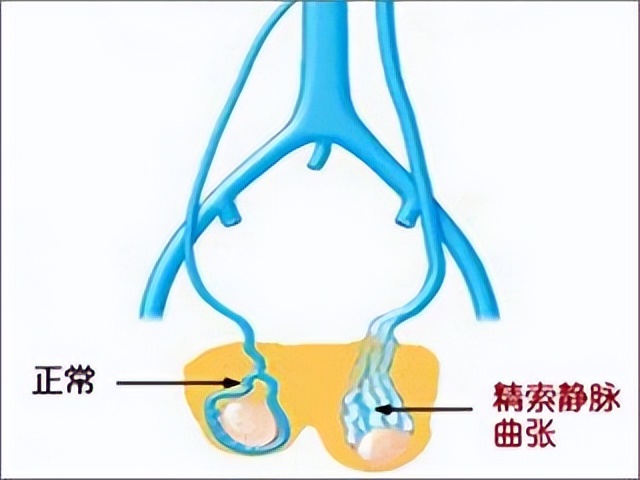 左侧精索静脉曲张 静脉曲张早期图片