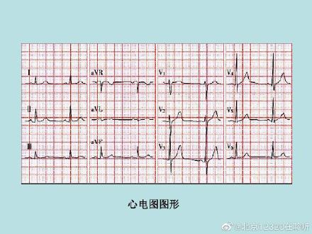 心电图怎么看 心电图上的数字怎么看