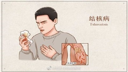 肺结核有什么症状 怎么判断自己肺部感染