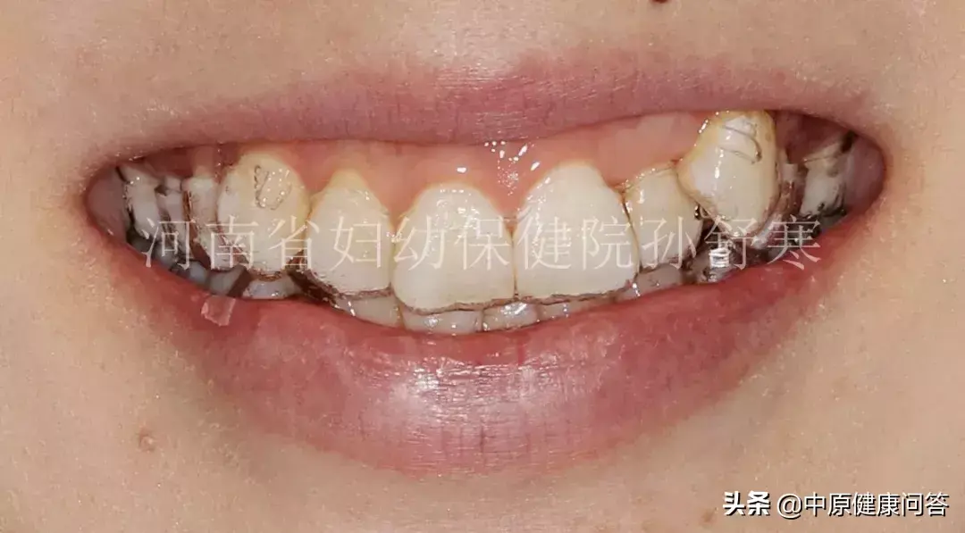 这个适合敏感的孩子：隐身牙套儿童牙齿矫正隐形牙套怎么戴