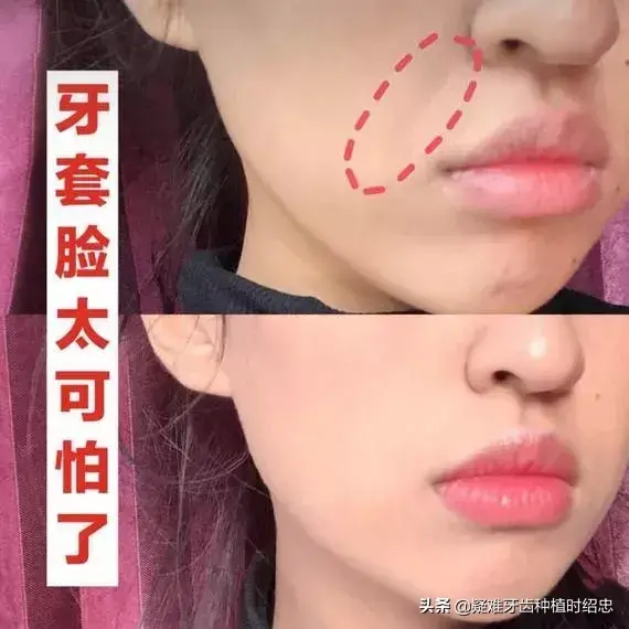 牙齿矫正过程中如何避免“牙套脸”？