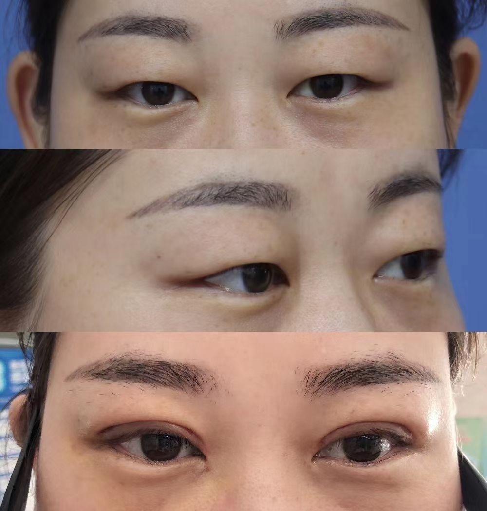 全切去皮去脂术后拆线对比-拆线双眼皮是全切吗