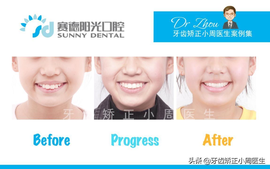 如何不靠整容改变下巴后缩-矫正牙能改善突突嘴吗