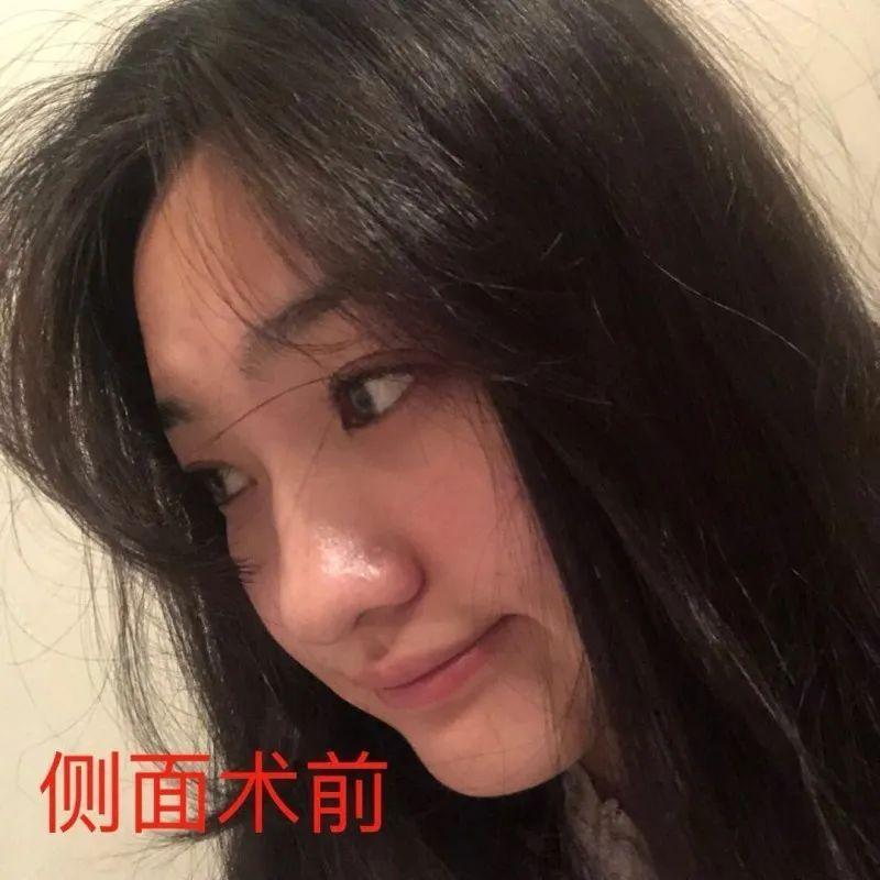 原来除了鼻梁，膨体垫鼻尖也可以如此自然美丽-假体耳软骨隆鼻好吗