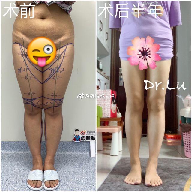 #大小腿吸脂#半年照片反馈-吸脂bodytite