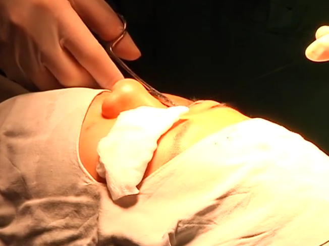 辽宁大连：女子爱美打玻尿酸一周后鼻子变黑溃烂流脓-玻尿酸多少钱打一针鼻子