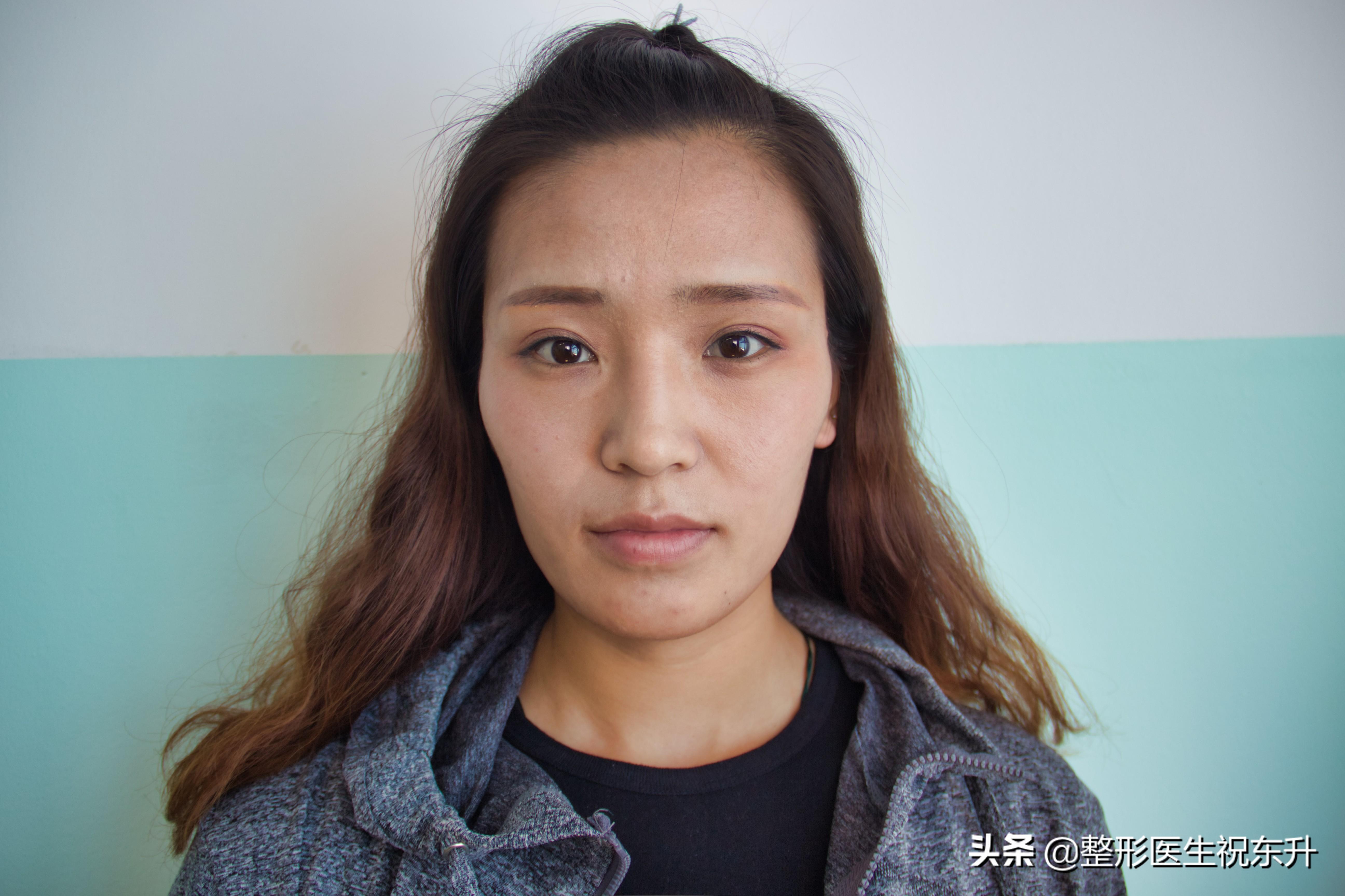 自体脂肪填充吸收快、成活少？我做完脸很好看-自体脂肪填充手术痛苦吗