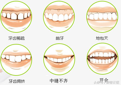 进行牙齿矫正的适宜年龄是多少？-几岁矫正牙齿合适