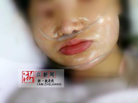 打完玻尿酸再打溶解酶清除折腾三次后脸肿成“猪头”玻尿酸溶解掉会造成什么影响