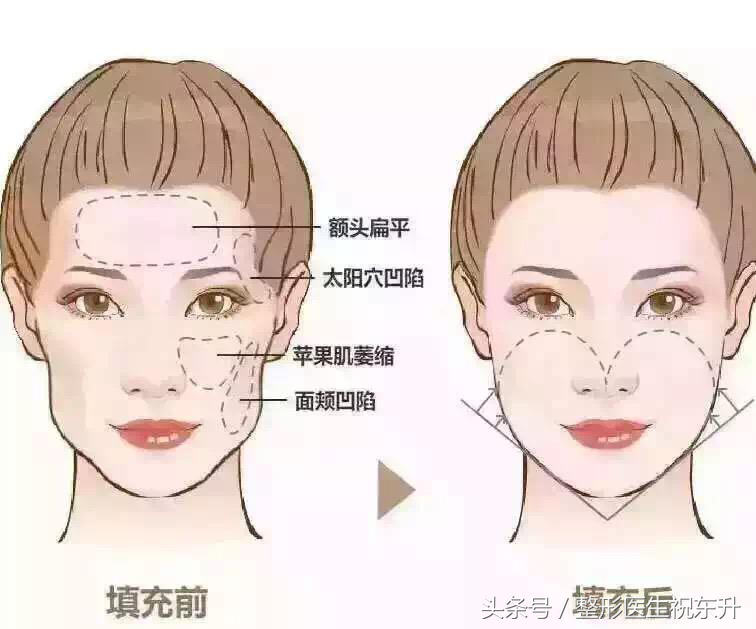 自体脂肪填充安全吗？并发症知多少？