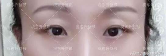 实例：全切双眼皮术后15天变化全程记录-全切双眼皮拆线后会有变化吗