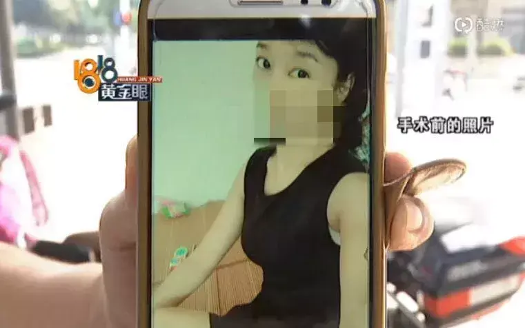惊！女子微整形却越整越丑，现在都“不敢出门”了-玻尿酸打卧蚕会变成眼袋吗