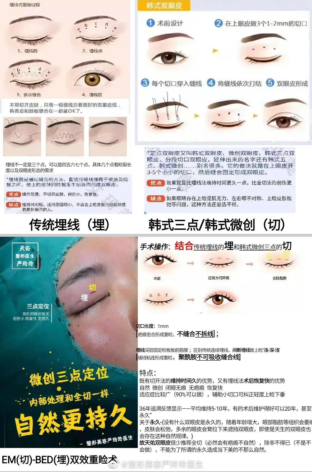 【三点小切口微创小切口微创切开术到底有什么优势？】-park双眼皮容易掉吗