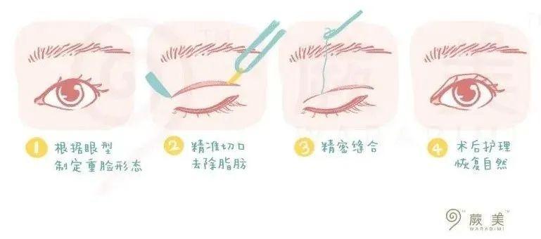 在外界争议之下，我到底该不该切双眼皮-八大处双眼皮哪个医生好