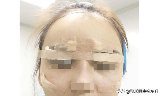 医生，面部自体脂肪填充后，多久才算脂肪存活下来？臀部自体脂肪填充能维持多久