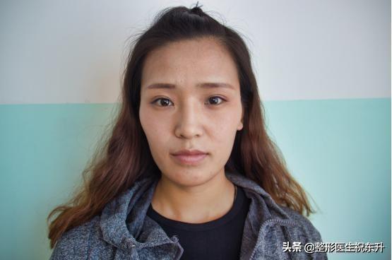 做脂肪填充能年轻近10岁！不信？可以参考一下她的“蜕变史”-自体脂肪填充案例对比图片