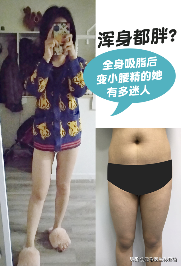 浑身都胖？全身吸脂后变小腰精的她有多迷人-抽脂瘦全身