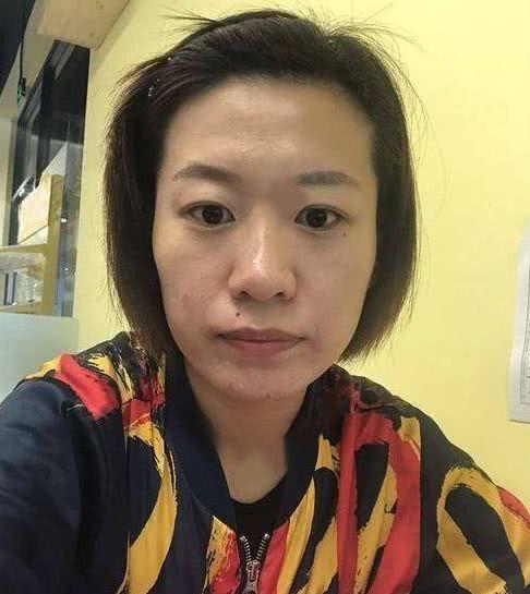 做了脂肪填充后，元气满满，皮肤好到不行，是我要的自然饱满年轻-脂肪填充怎样