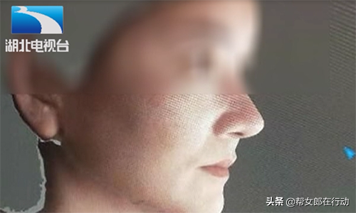 女子花6万元隆鼻，却假体感染数月流脓，这鼻子还保得住吗？-假体隆鼻一共多少钱一次