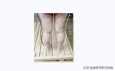 患者自述腿部吸脂的经历-减肥大腿吸脂