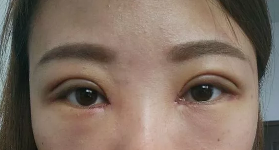 双眼皮肉条多久能消，肉条感明显会自己恢复吗？-割的双眼皮的痕迹怎么去掉