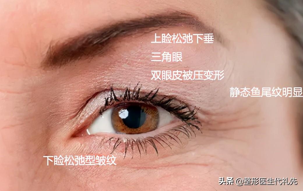 三个提眉手术真人案例，来看看被称为眼周小拉皮手术术前术后对比-双眼皮拉皮图片
