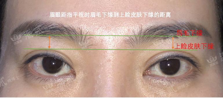 割双眼皮后眉毛离眼睛太近了！很显凶！做双眼皮修复能拉开吗？-双眼皮割的窄了怎么办图片