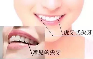 虎牙可以拔了吗？最好是不要！-虎牙牙齿矫正要多少钱